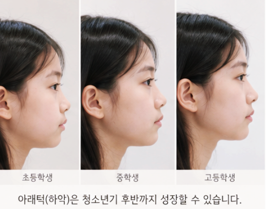 초등학생, 중학생, 고등학생의 옆모습을 비교한 사진으로, 아래턱(하악)이 청소년기 후반까지 성장할 수 있음을 보여줍니다.